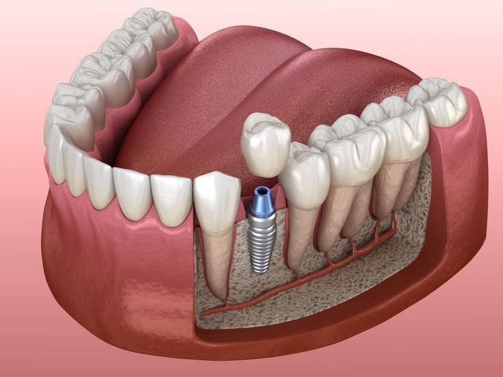 Diagrama de un implante dental mostrando el tornillo, el pilar y la corona